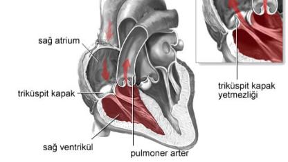 Türkiye TRİKÜSPİD tedavisinde dünya devleriyle yarışıyor
