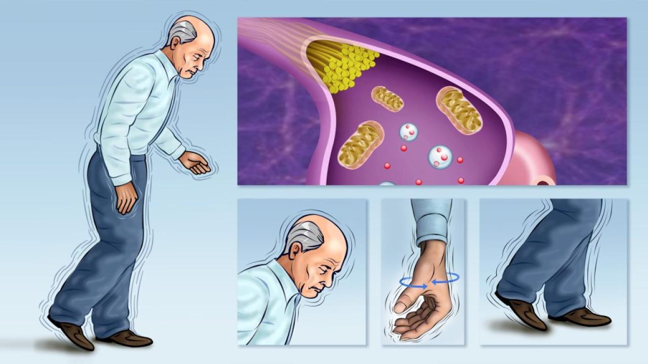 Parkinson ve Demansa karşı hücresel kalkan: Kök Hücre umudu
