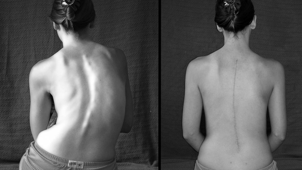 Skolyoz belirtileri nelerdir? Erken teşhis neden önemli ?