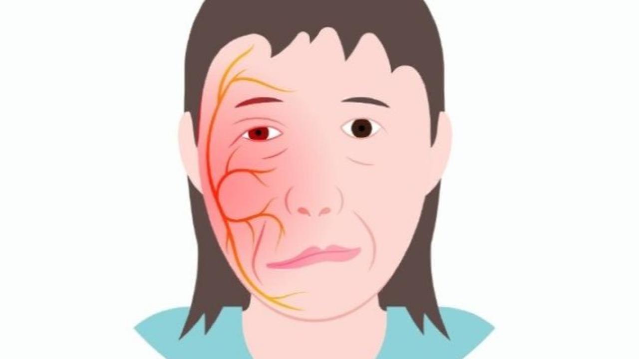Yüzde elektrik çarpması hissi: Trigeminal Nevraljiye son