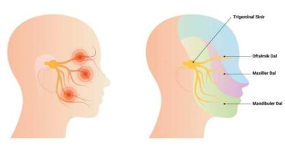 Yüzde elektrik çarpması hissi: Trigeminal Nevraljiye son